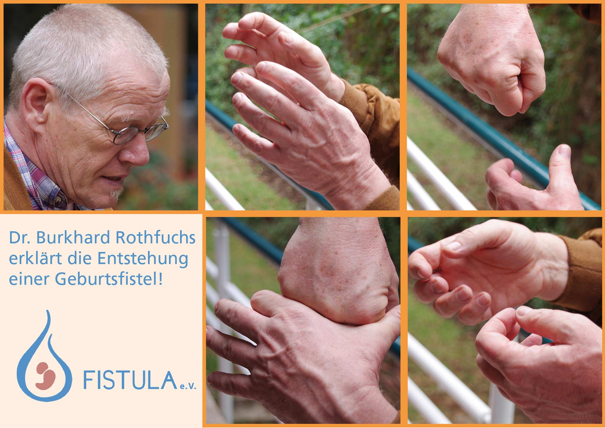 Fistula Vortrag 2018 Dr. Burkhard Rothfuchs